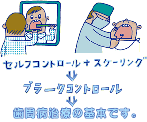 歯周病の治療は プラークコントロールから 歯周病の治療は プラークコントロールから